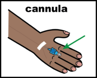 Cannula (on back of hand)