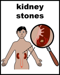 Kidney stones