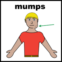 Mumps