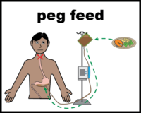 Peg feed with tummy