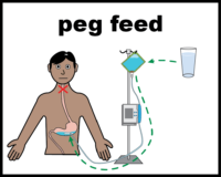 Peg feed with tummy fluids
