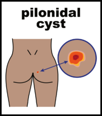 Pilonidal cyst