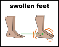 Swollen feet