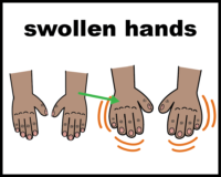 Swollen hands