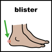 blister on foot