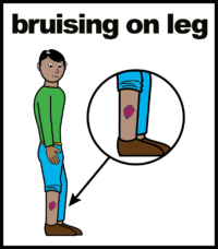 bruising on leg