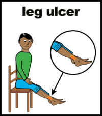 leg ulcer V2