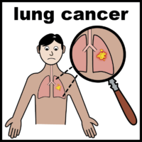 lung cancer