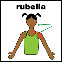 rubella