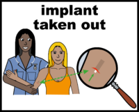 contraception implant taken out