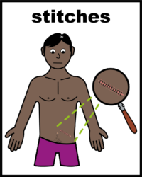 stitches V2