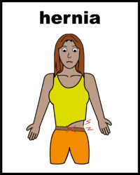 hernia belt