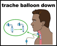 trache balloon down