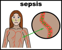 sepsis