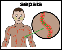 sepsis V2