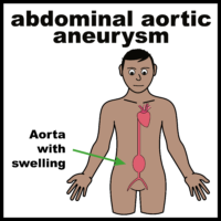 Thumbnail for Abdominal aortic aneurysm (AAA) Screening 