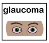 Thumbnail for Glaucoma