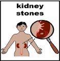Thumbnail for Kidney stones