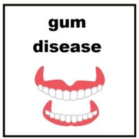 Thumbnail for Gum Disease