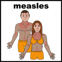 Thumbnail for Measles