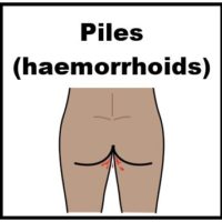 Thumbnail for Piles (haemorrhoids)