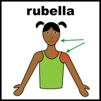 Thumbnail for Rubella