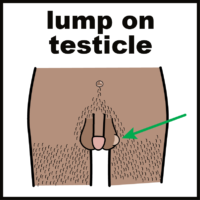 Thumbnail for Testicle lumps and swellings 
