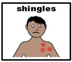 Thumbnail for Shingles