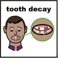 Thumbnail for Tooth decay