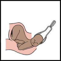Forceps Birth