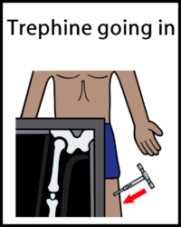Bone biopsy trephine going in