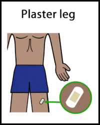Bone biopsy plaster leg