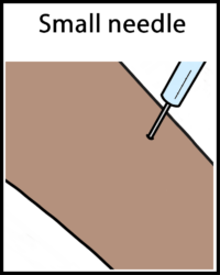 Bone biopsy small needle