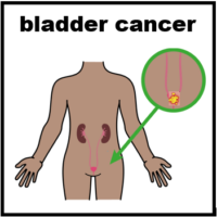 Thumbnail for Bladder Cancer 