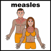 Thumbnail for Measles, Mumps and Rubella 